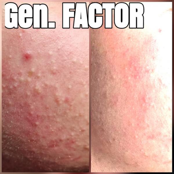 gen-factor